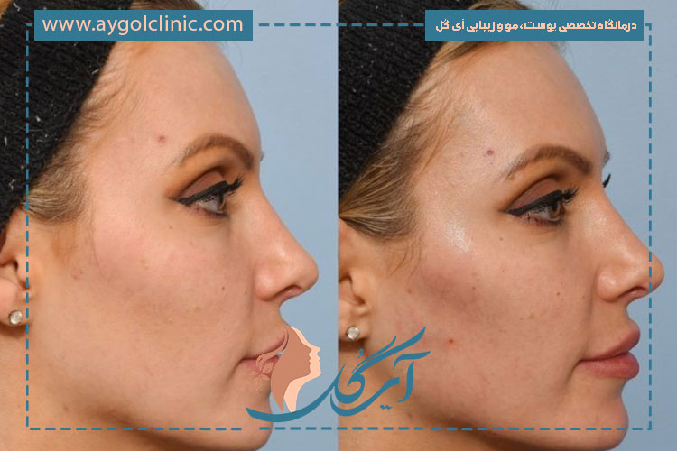 فیلر زاویه فک برای آقایان روشی مؤثر جهت ایجاد فک قوی و چهره مردانه‌تر است.