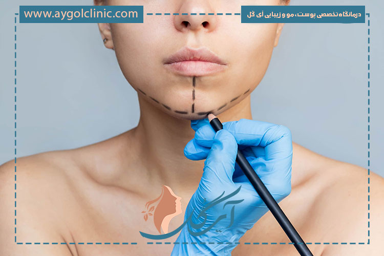 تزریق فیلر زاویه فک باعث فرم‌دهی، تقارن و افزایش جذابیت چهره می‌شود.