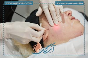 اندولیفت چیست؟ + روش انجام و تاثیرات آن برای صورت و بدن