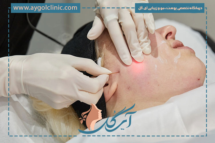 اندولیفت چیست؟ تاثیر اندولیفت روی زیبایی بدن و صورت