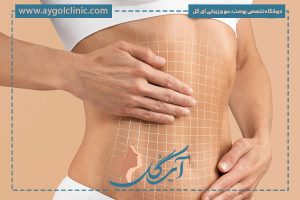 اندولیفت شکم؛ راهی نو برای رفع افتادگی و چربی‌های موضعی