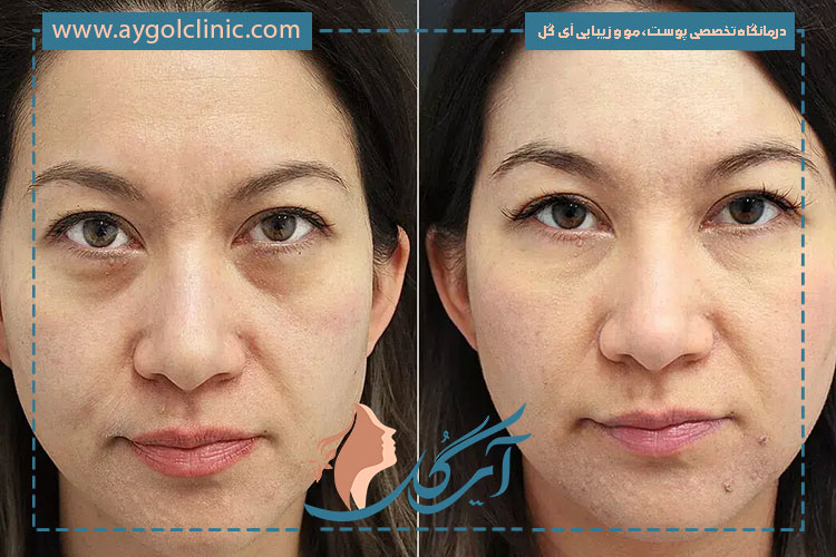 ماندگاری نتایج اندولیفت زیر چشم چقدر است و چه عواملی بر دوام آن تأثیر دارد