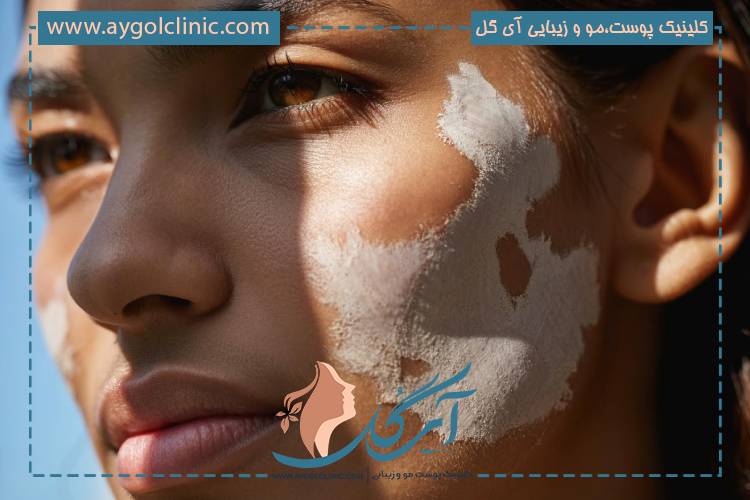 عوارض بلندمدت لیزر CO2 ممکن است شامل تغییر رنگ پوست، اسکار یا حساسیت ماندگار باشد.