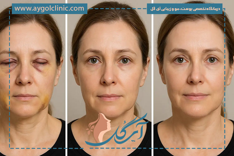 مقایسه مزایا و معایب حمام آب گرم یا سرد پس از بلفاروپلاستی برای ترمیم بهتر