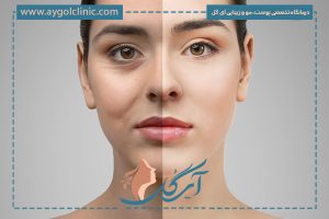 حمام بعد از بلفاروپلاستی؛ نکات ضروری برای دوران نقاهت