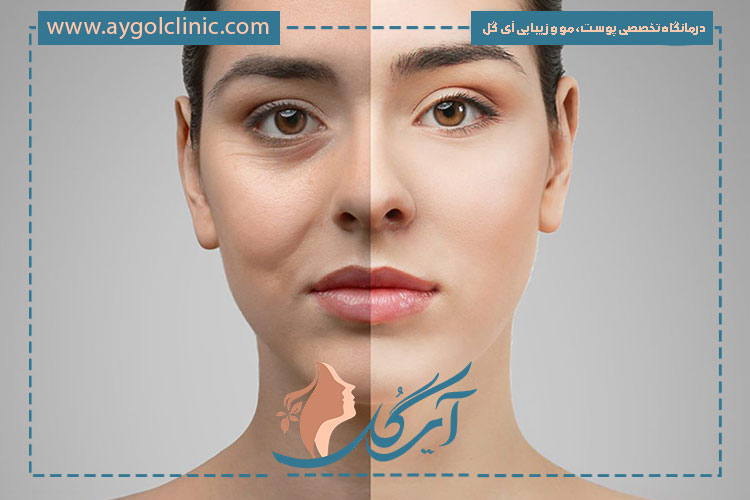 راهنمای کامل درباره زمان مناسب و ایمن برای حمام رفتن بعد از بلفاروپلاستی