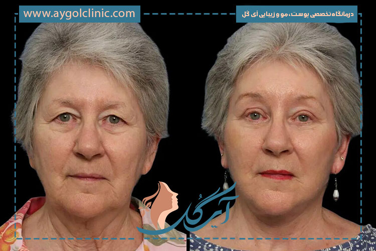 بررسی اثر بخار و دوش آب گرم بر بخیه‌های بلفاروپلاستی و روند بهبودی پلک