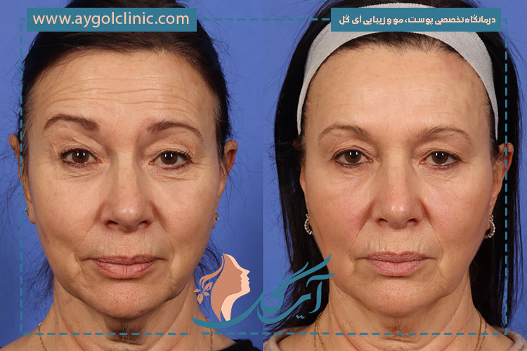 درد و تورم سه روز بعد از تزریق بوتاکس با توجه به نکات لازم برای تسکین بهتر