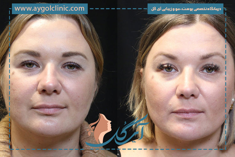 هزینه اندولیفت پیشانی بسته به نوع دستگاه، مهارت پزشک و وسعت ناحیه متفاوت است