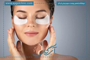 اندولیفت زیر چشم چیست؟ | ماندگاری، مزایا و هزینه لیفت دور چشم