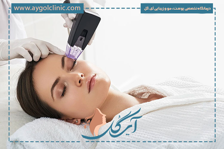 آر اف فرکشنال چیست و چگونه به بهبود کیفیت پوست و جوانسازی طبیعی و موثر کمک می‌کند