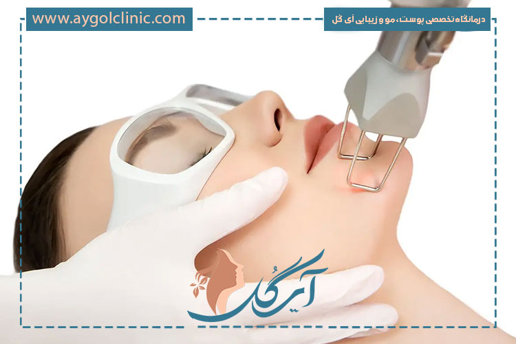 عوامل مؤثر بر ماندگاری لیزر فرکشنال شامل مراقبت، عمق درمان و سبک زندگی