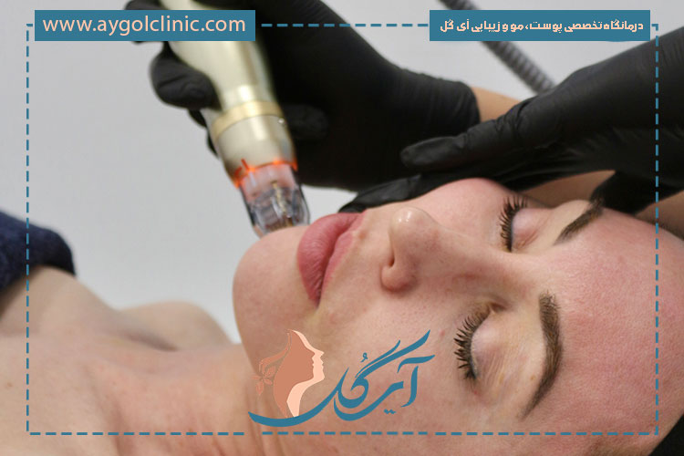 عوارض آر اف فرکشنال شامل واکنش‌های موقت پوستی و نیاز به مراقبت مناسب است