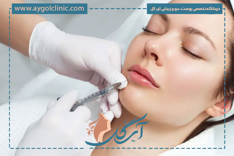 کاربرد فیلر رووفیل برای شقیقه جهت جوانسازی چهره و بهبود تقارن صورت طبیعی