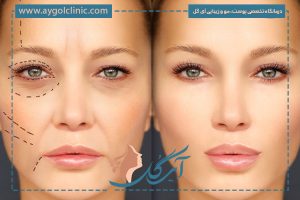 تزریق فیلر فول فیس؛ کاربردها، مزایا و مراقبت‌ها برای جوانسازی چهره