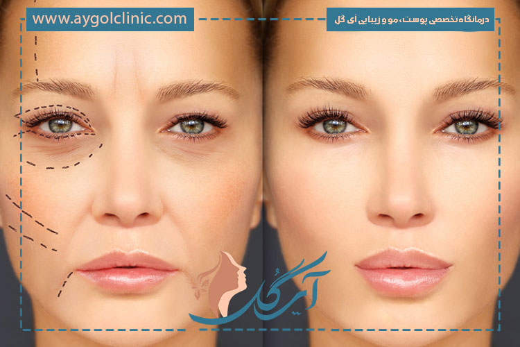 تزریق فیلر فول فیس چیست و چگونه به جوانسازی و تناسب طبیعی چهره کمک می‌کند