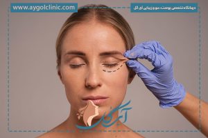 اندولیفت پلک چیست؟ هر آنچه باید بدانید: ماندگاری، مزایا و کاربرد