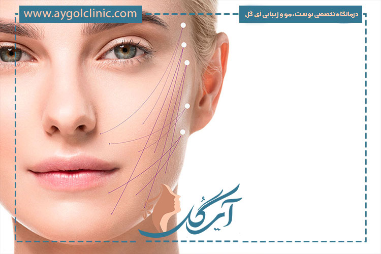 عوارض اندولیفت پلک اغلب خفیف و موقتی بوده و شامل تورم یا قرمزی کوتاه‌مدت است