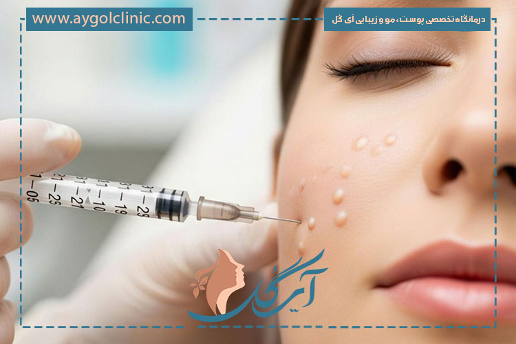 مزوتراپی پوست برای تقویت، آبرسانی و رفع لک و تیرگی