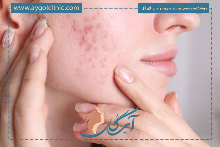 اطلاعات کامل درباره اینکه هزینه اندولیفت جای جوش صورت چقدر است و به چه عواملی بستگی دارد