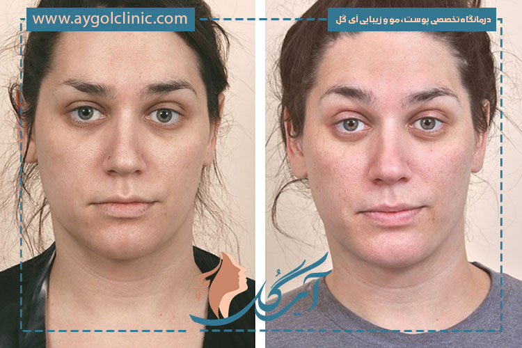مزایای لیفت شقیقه با جراحی برای فرم‌دهی چشم و ابرو