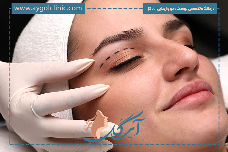 ماندگاری اندولیفت پلک معمولاً بین یک تا سه سال بوده و به کیفیت پوست بستگی دارد