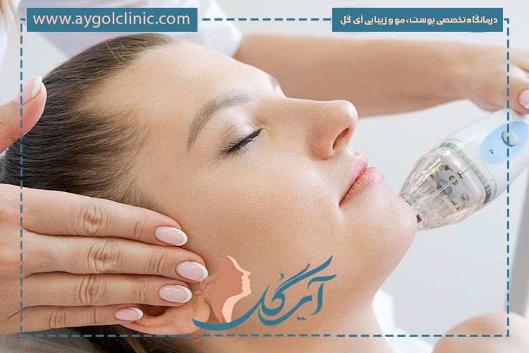 انواع میکرونیدلینگ و تفاوت روشها در بهبود بافت پوست و افزایش شفافیت