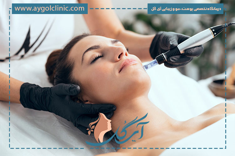 کاربردهای میکرونیدلینگ چیست و چه نقش مؤثری در درمان لک و جای جوش دارد