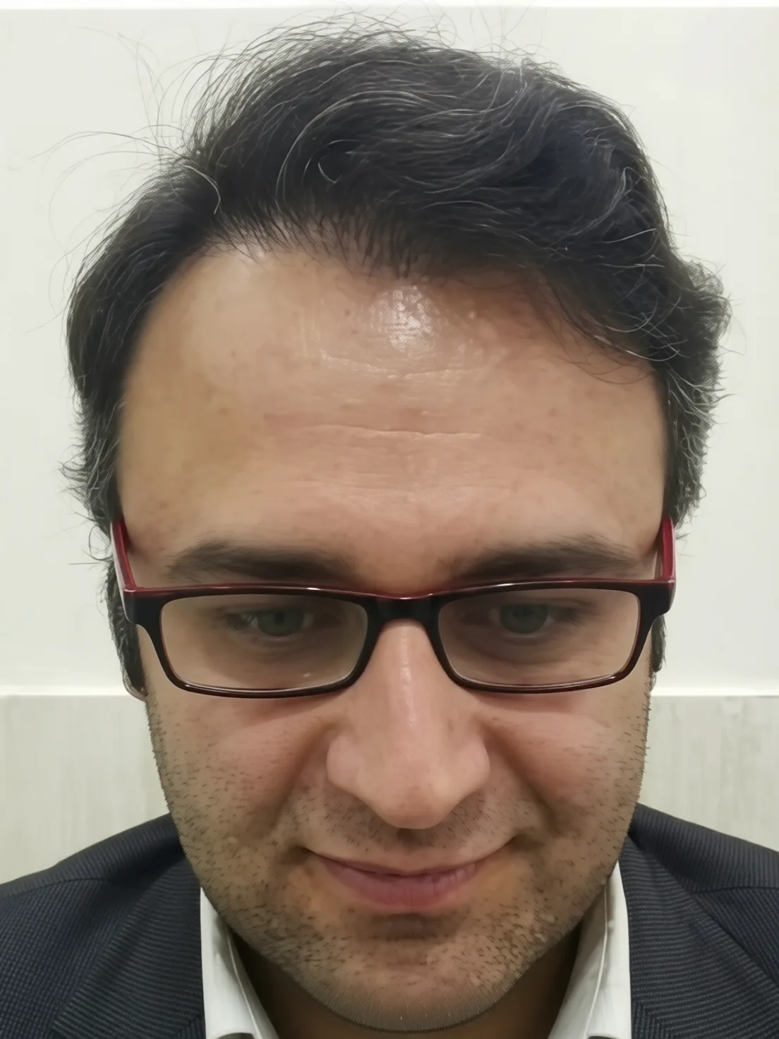 کاشت مو