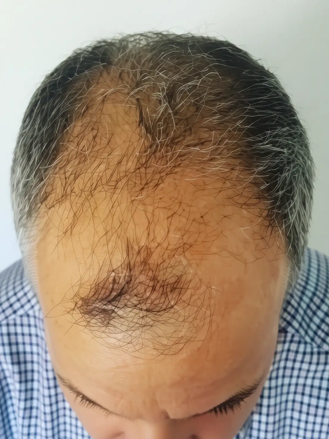 کاشت مو