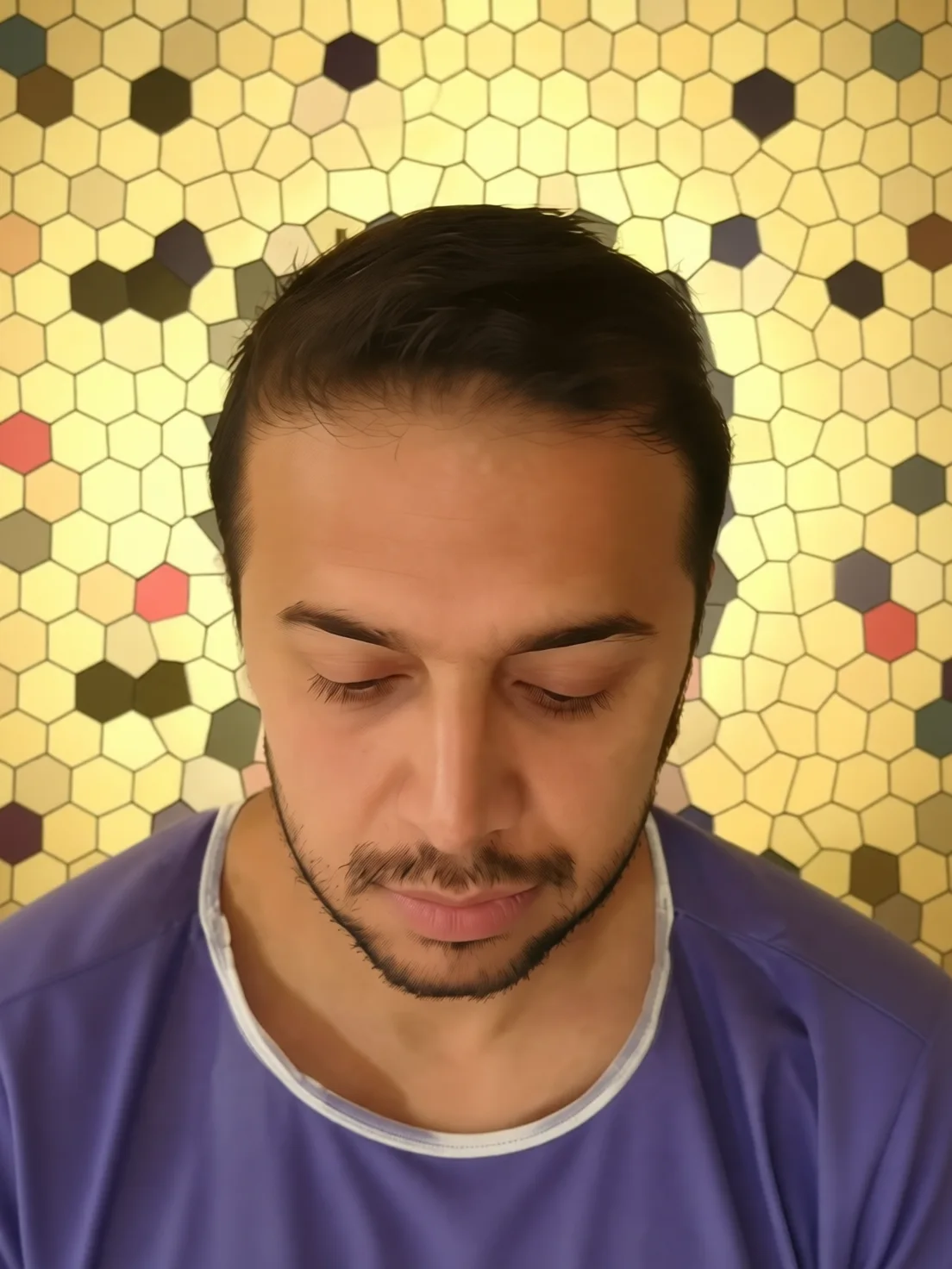 کاشت مو