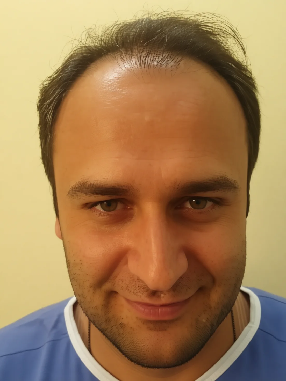 کاشت مو