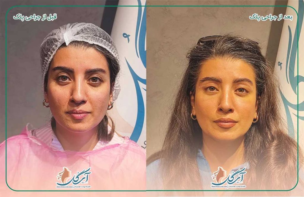 خدمات بلفاروپلاستی