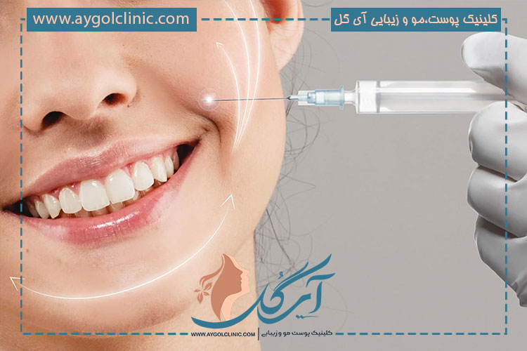 میزان ماندگاری تزریق فیلر خط خنده