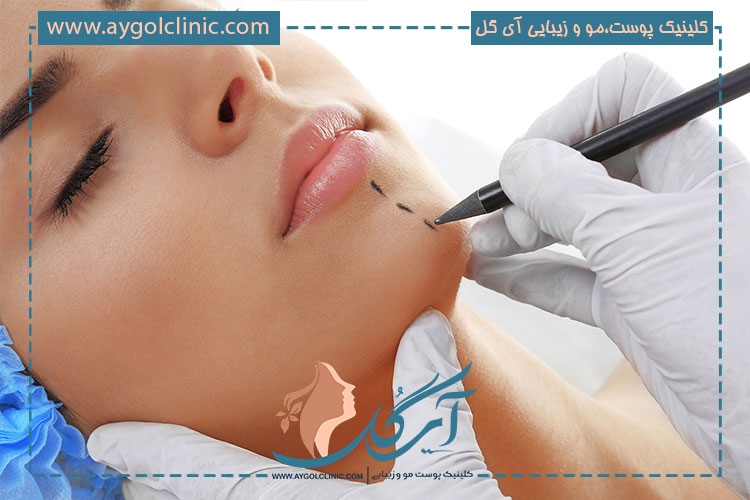 برای زاویه سازی فک و چانه از چه مواد استفاده می شود؟