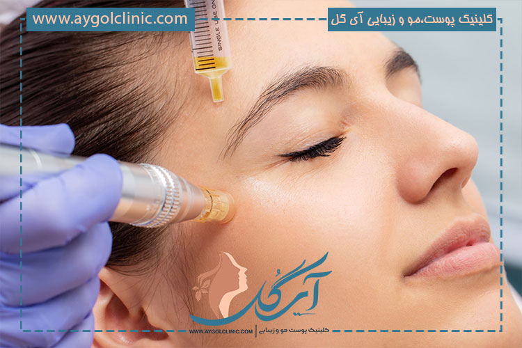 مزونیدلینگ پوست سر چگونه انجام میشود؟
