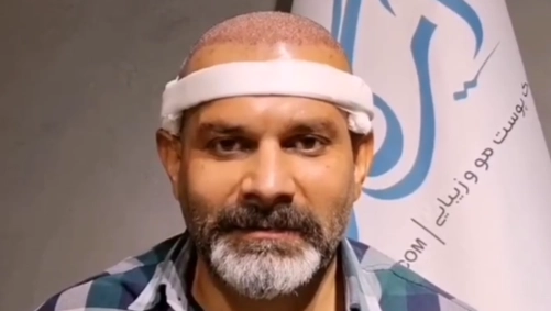 کاور ویدیو کاشت مو