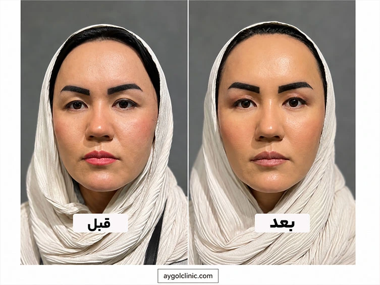 نمونه کار بلفاروپلاستی پلک بالا 