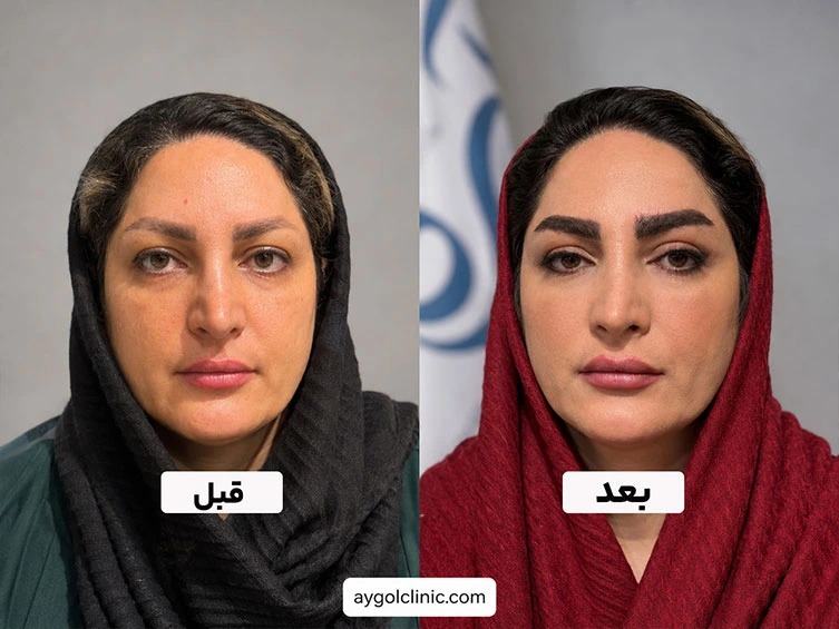 عکس قبل و بعد جراحی بلفاروپلاستی پلک بالا 