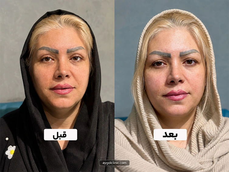 رفع پف و افتادگی پلک بالا با بلفاروپلاستی