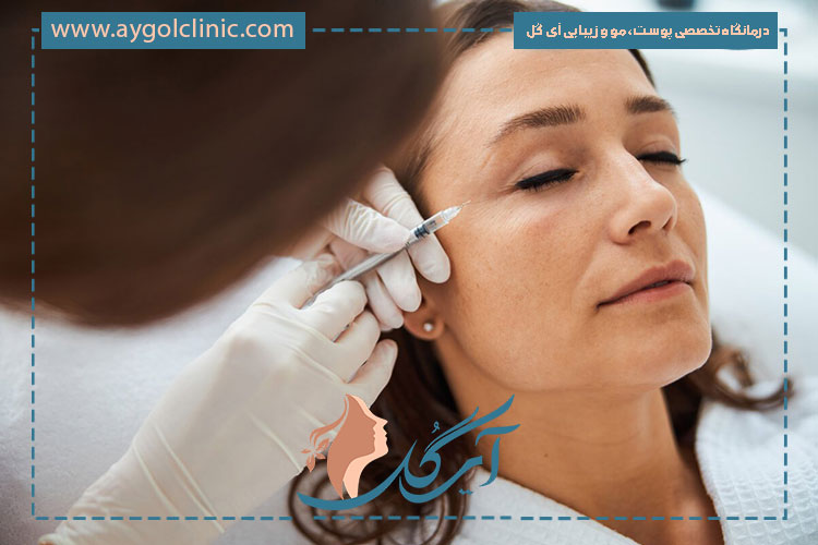 فیلر شقیقه