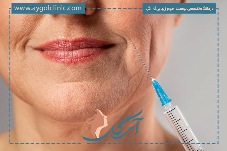 ماندگاری بوتاکس فول فیس بین ۳ تا ۶ ماه بسته به شرایط بدن