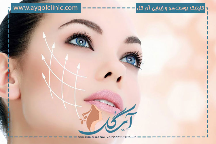 فیلر خط خنده ارزان برای رفع چروک اطراف لب + نتیجه ماندگار 🌸