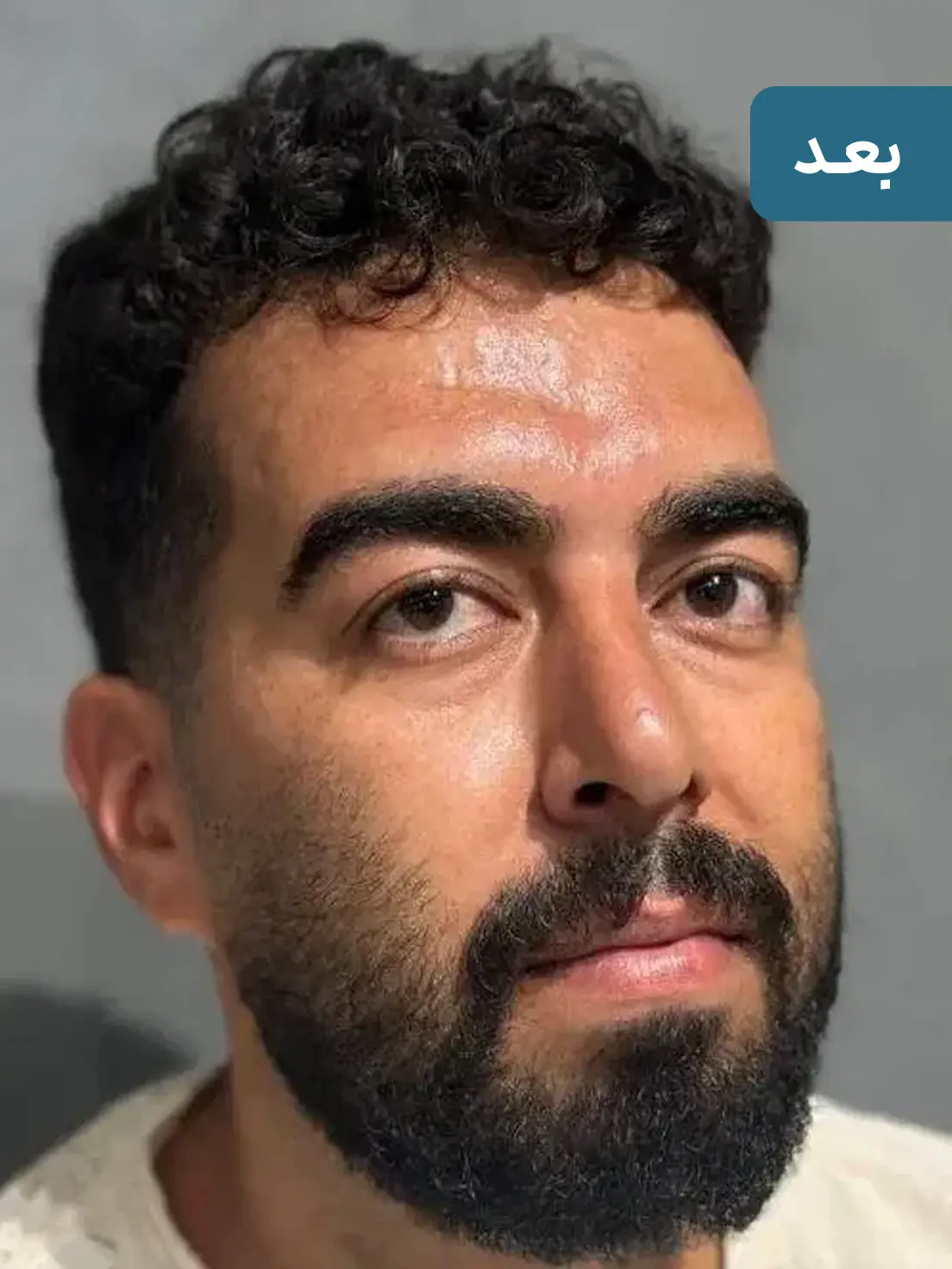 بلفاروپلاستی