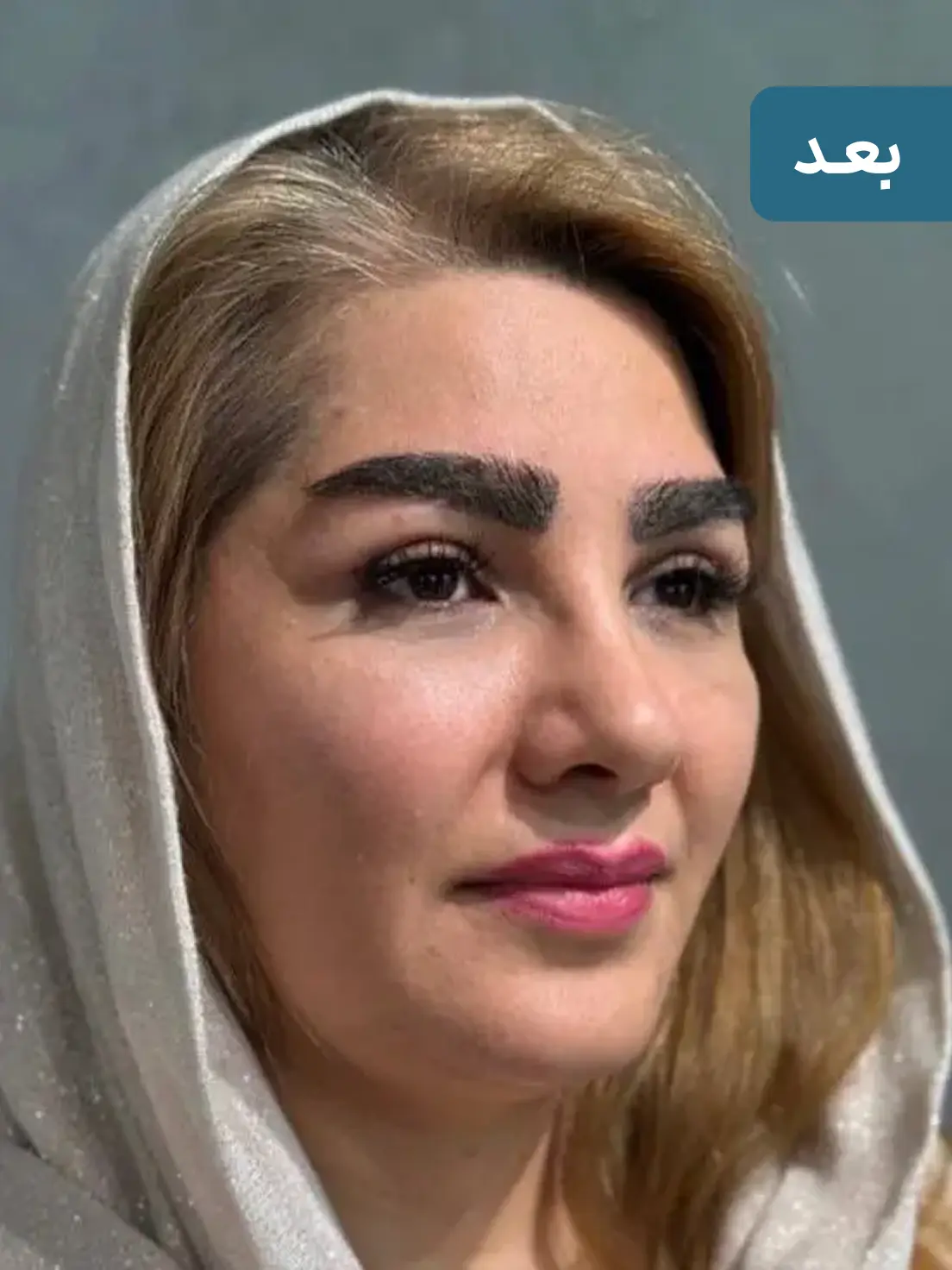 بلفاروپلاستی