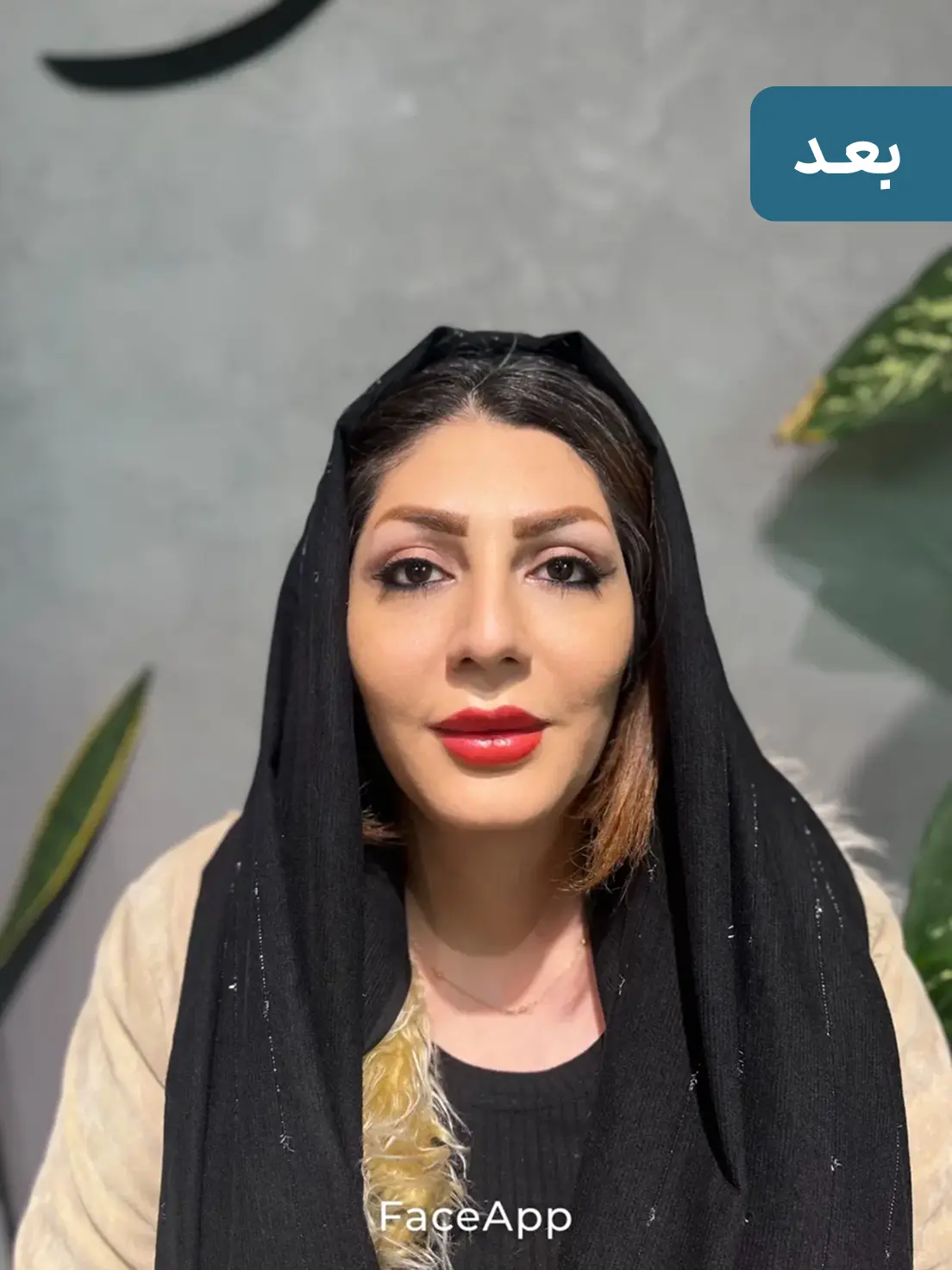 بلفاروپلاستی