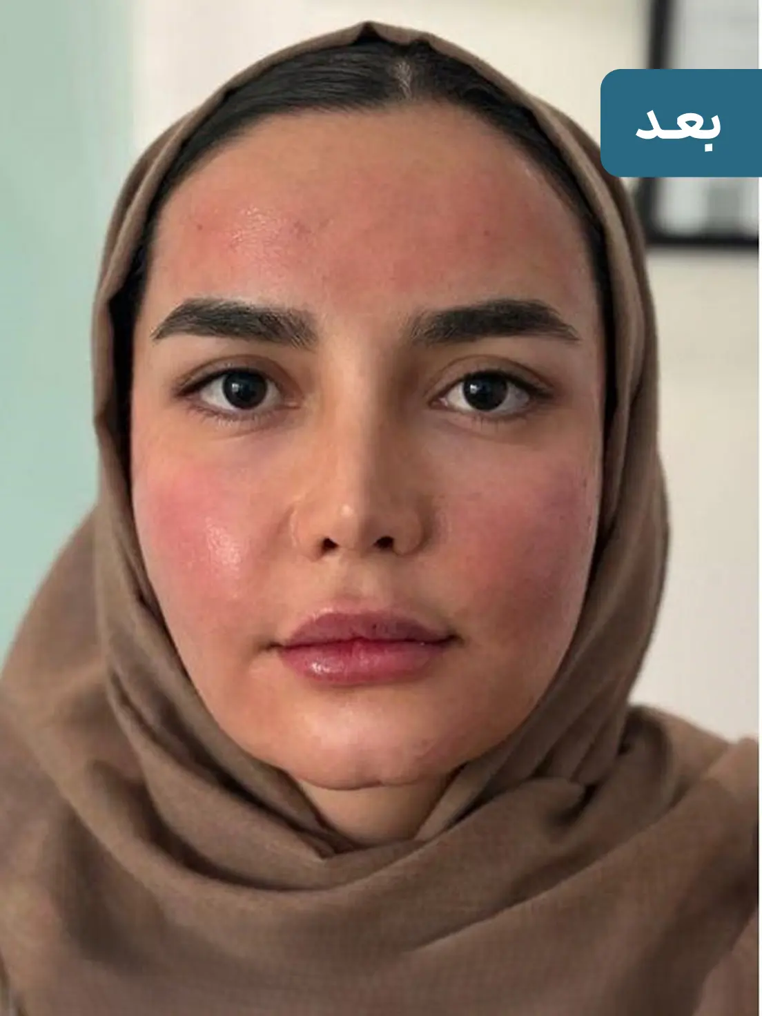 فیلر خط خنده ارزان برای رفع چروک اطراف لب + نتیجه ماندگار 🌸