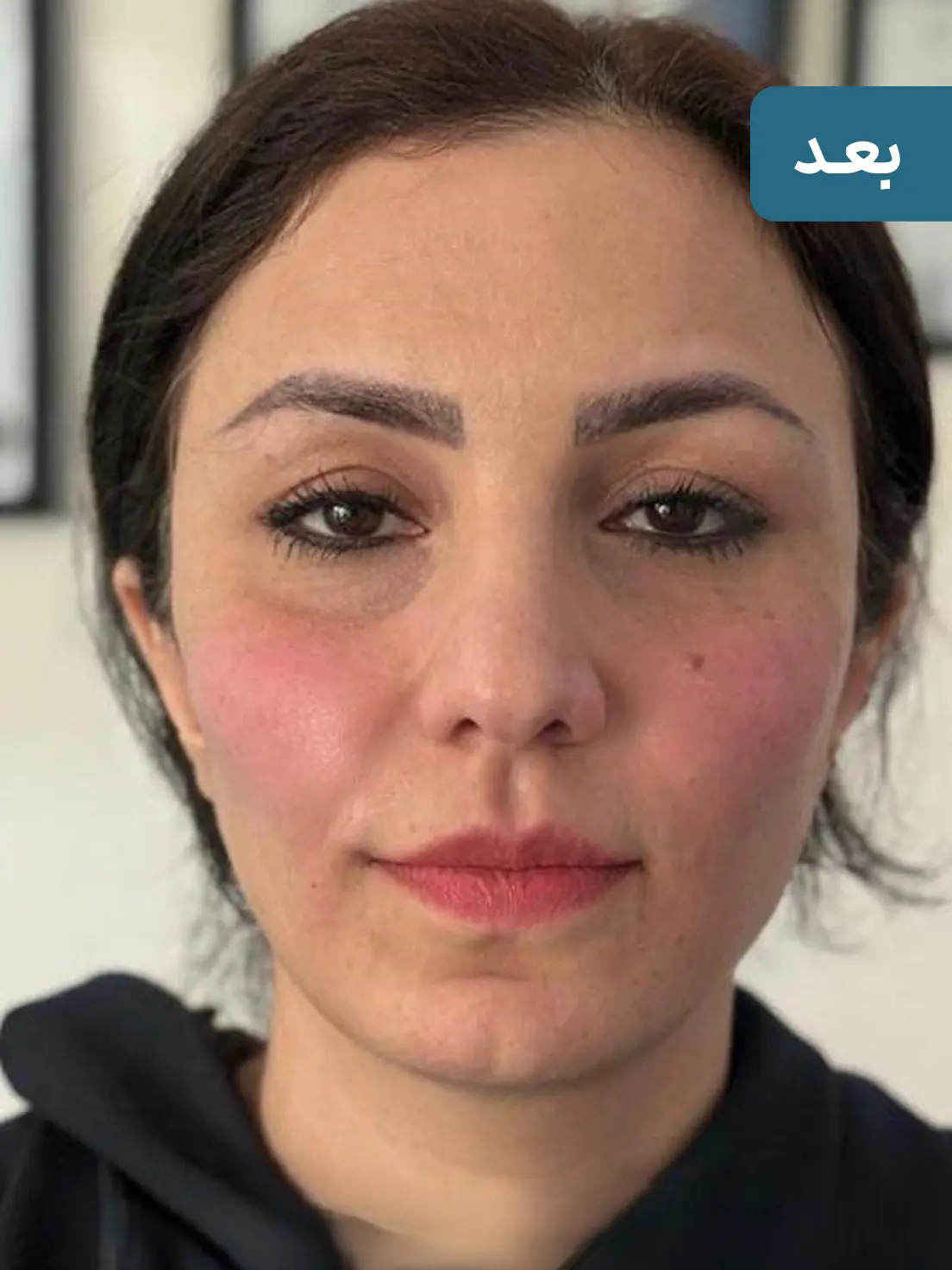 فیلر خط خنده ارزان برای رفع چروک اطراف لب + نتیجه ماندگار 🌸