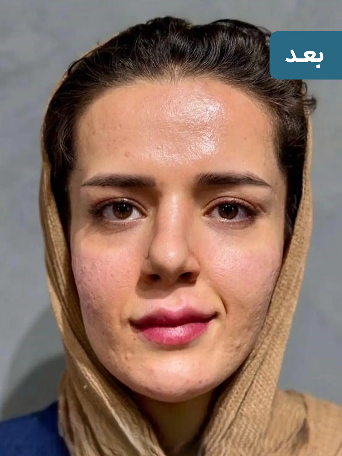 فیلر خط خنده ارزان برای رفع چروک اطراف لب + نتیجه ماندگار 🌸