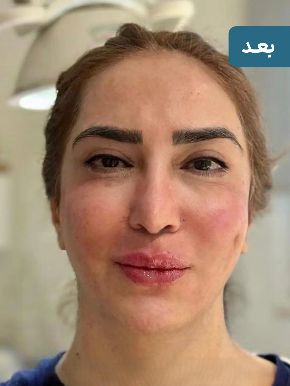 فیلر خط خنده ارزان برای رفع چروک اطراف لب + نتیجه ماندگار 🌸